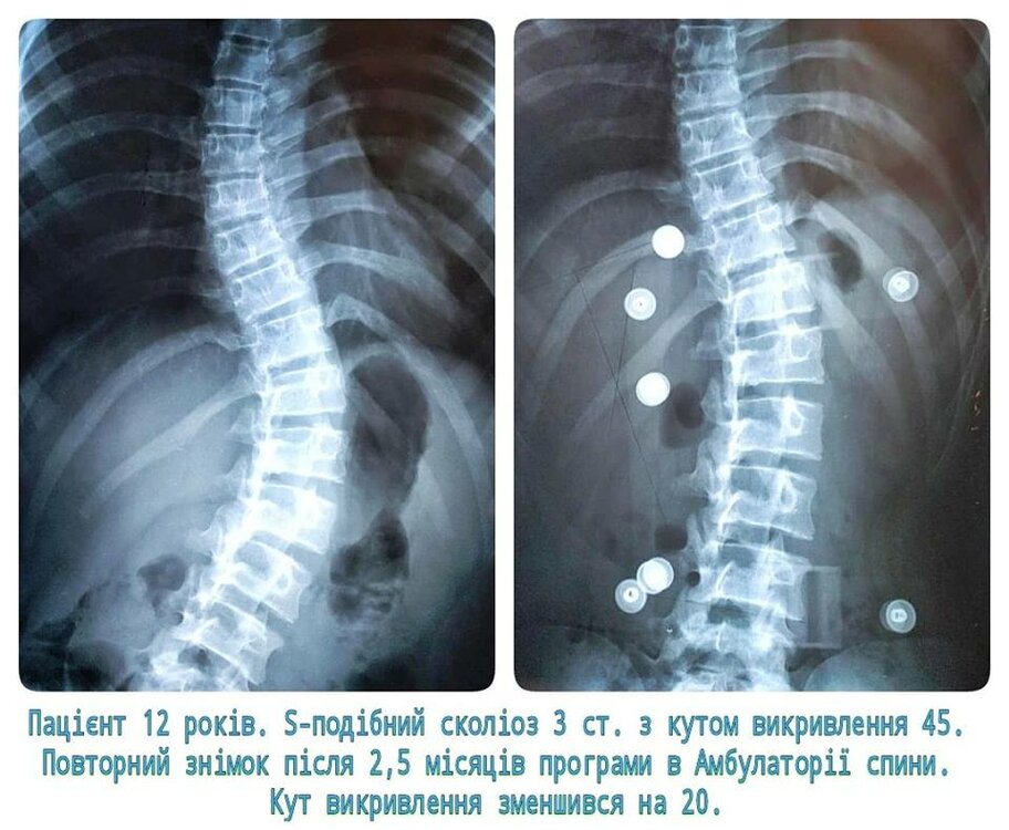 988503295_scoliosisx-ray.thumb.jpg.81c5f907ab6dde9c61e553171d8724dc.jpg